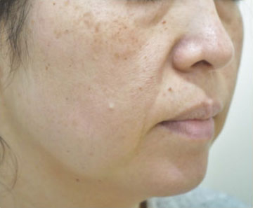症例2　 頬の肝斑、老人性色素斑 治療前