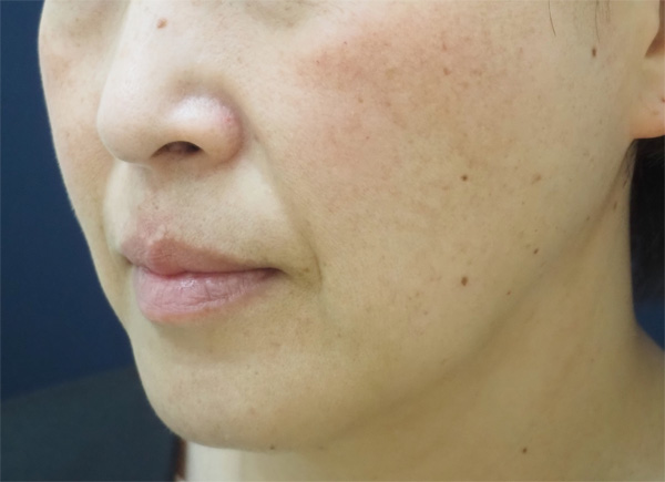 症例3　頬の肝斑、そばかす、老人性色素斑 治療後
