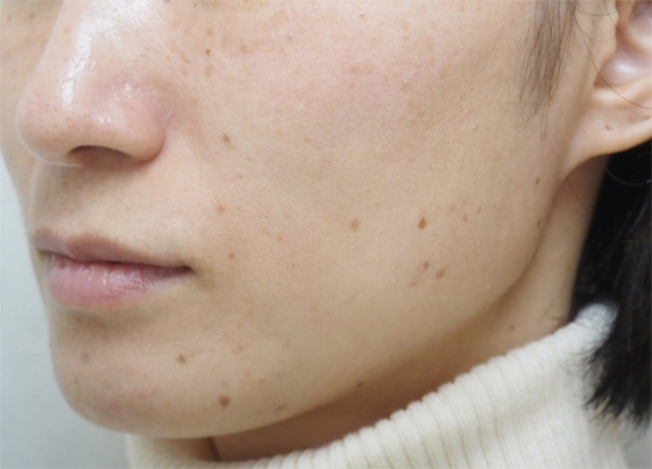 症例13　老人性色素斑（顔全体）フォトフェイシャル治療 治療前