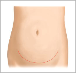 脂肪吸引＋腹壁形成術（タミータック手術）2