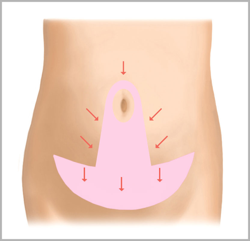 脂肪吸引＋腹壁形成術（タミータック手術）1