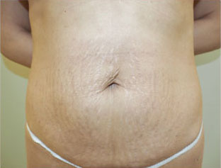 症例1　腹部の脂肪吸引＋腹壁形成術（タミ―タック手術） 手術前
