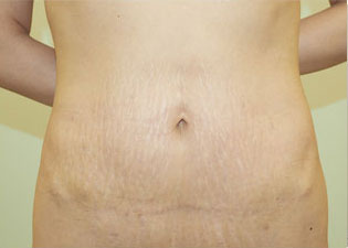 症例1　腹部の脂肪吸引＋腹壁形成術（タミ―タック手術） 手術後
