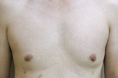 症例12　男性の女性化乳房に対する脂肪吸引 手術後