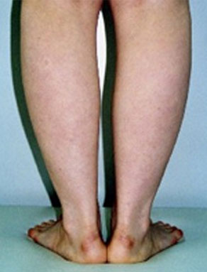 症例3　ふくらはぎ・足首の脂肪吸引 手術前