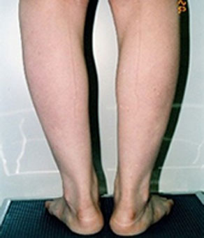 症例3　ふくらはぎ・足首の脂肪吸引 手術後