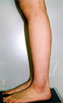 症例4　ふくらはぎ・足首の脂肪吸引 手術前