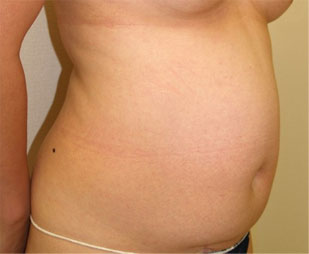 症例2　腹部の脂肪吸引 手術前