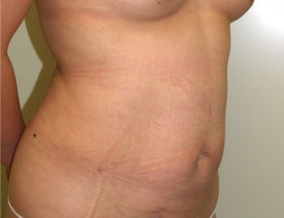 症例2　腹部の脂肪吸引 手術後