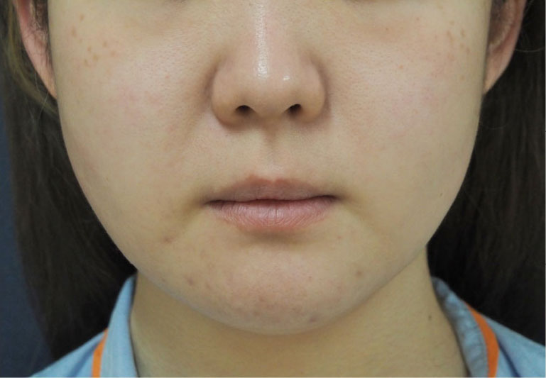 症例3　頬の脂肪吸引 手術前