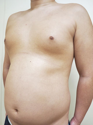症例4　胸部・腹部の脂肪吸引 手術前