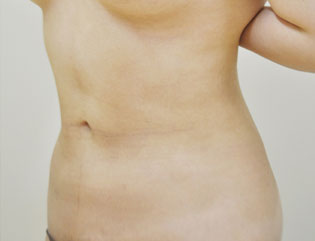 症例5　腹部の脂肪吸引 手術後