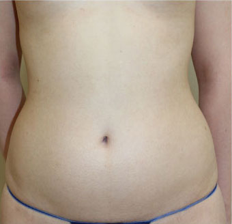 症例6　腹部の脂肪吸引 手術前