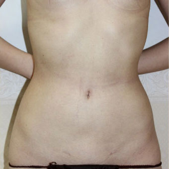 症例6　腹部の脂肪吸引 手術後