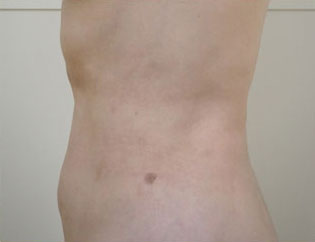 症例7　腹部・腰部の脂肪吸引 手術後