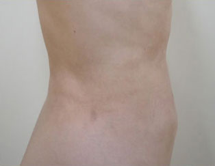 症例7　腹部・腰部の脂肪吸引 手術後