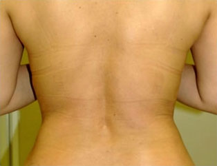 症例8　背部の脂肪吸引 手術後