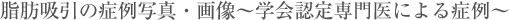 脂肪吸引の症例写真・画像〜学会認定専門医による症例〜