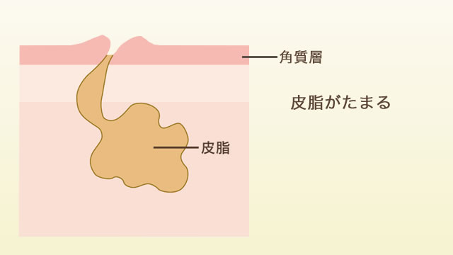 ニキビができるしくみ2