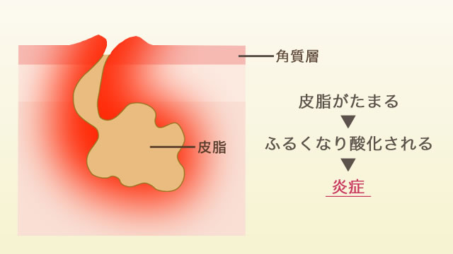 ニキビができるしくみ3