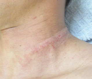 症例11　刺青（タトゥー）除去（切縫法） 手術後