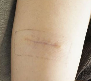 症例12　刺青（タトゥー）除去（切縫法） 手術後