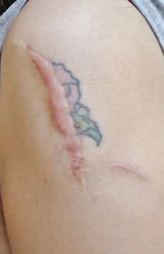 症例13　刺青（タトゥー）除去（他院切縫法後） 手術前