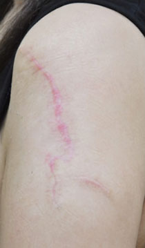 症例13　刺青（タトゥー）除去（他院切縫法後） 手術後