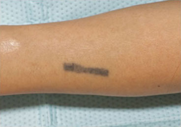 症例15　刺青（タトゥー）除去（切縫法） 手術前