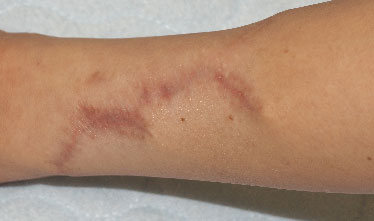 症例16　刺青（タトゥー）除去（切縫法） 手術後
