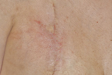 症例18　刺青（タトゥー）除去（切縫法） 手術後