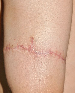 症例19　刺青（タトゥー）除去（切縫法） 手術後
