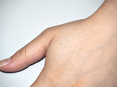 症例1　刺青（タトゥー）除去（レーザー） 治療前(左親指つけね)