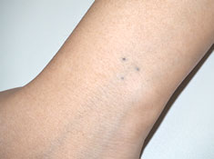 症例1　刺青（タトゥー）除去（レーザー） 治療前(左手首)
