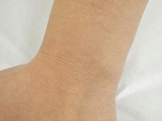 症例1　刺青（タトゥー）除去（レーザー） 治療後(左手首)