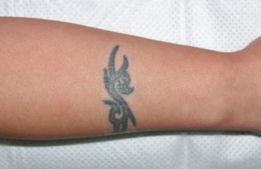 症例20　刺青（タトゥー）除去（切縫法） 手術前