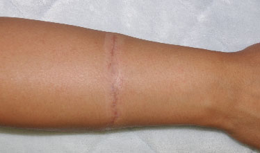 症例20　刺青（タトゥー）除去（切縫法） 手術後