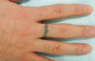 症例23　刺青（タトゥー）除去（切縫法） 手術前