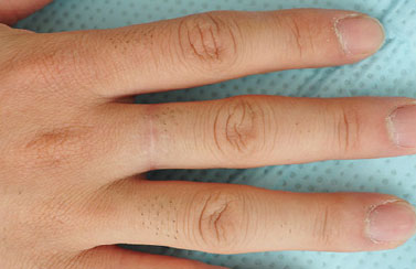 症例23　刺青（タトゥー）除去（切縫法） 手術後