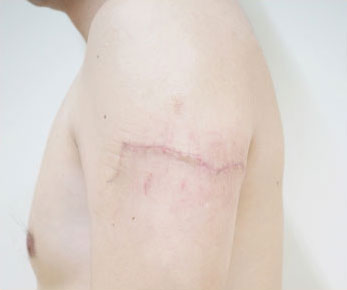 症例24　刺青（タトゥー）除去（切縫法） 手術後