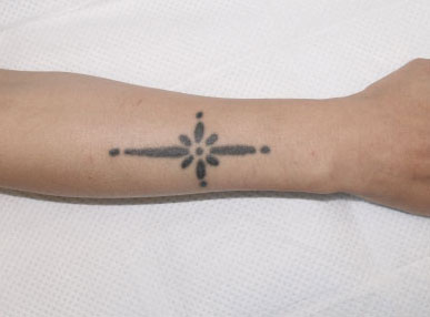 症例25　刺青（タトゥー）除去（切縫法） 手術前