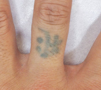 症例26　刺青（タトゥー）除去（レーザー治療後に植皮法手術） レーザー手術後