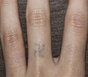 症例2　刺青（タトゥー）除去（レーザー） 治療前