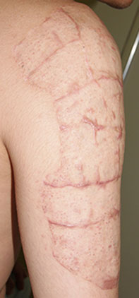 症例30　刺青（タトゥー）除去（植皮法）手術後