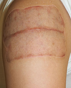 症例31　刺青（タトゥー）除去（植皮法） 手術後