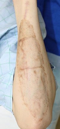症例32　刺青（タトゥー）除去（植皮法） 手術後