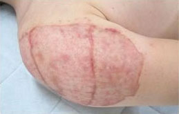 症例33　刺青（タトゥー）除去（植皮法） 手術後1ヶ月半
