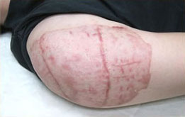 症例33　刺青（タトゥー）除去（植皮法） 手術後2ヶ月半