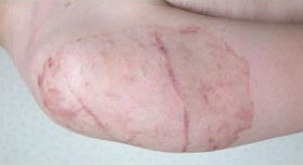 症例33　刺青（タトゥー）除去（植皮法） 手術後9ヶ月