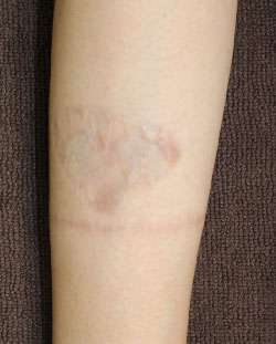 症例34　刺青（タトゥー）除去（植皮法） 手術後